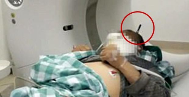 Başına 20 sm uzunluğunda dəmir parçası batmış fəhlə sağ qaldı - FOTO