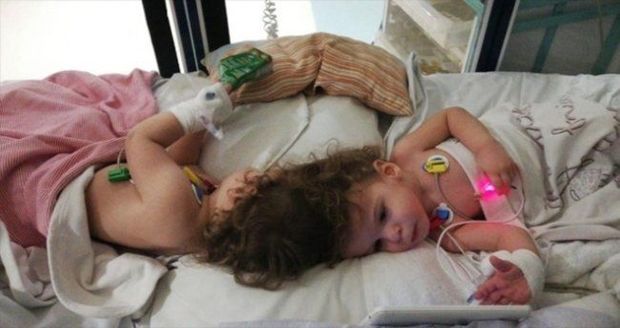 Siam əkizlərini ayırdılar - FOTO