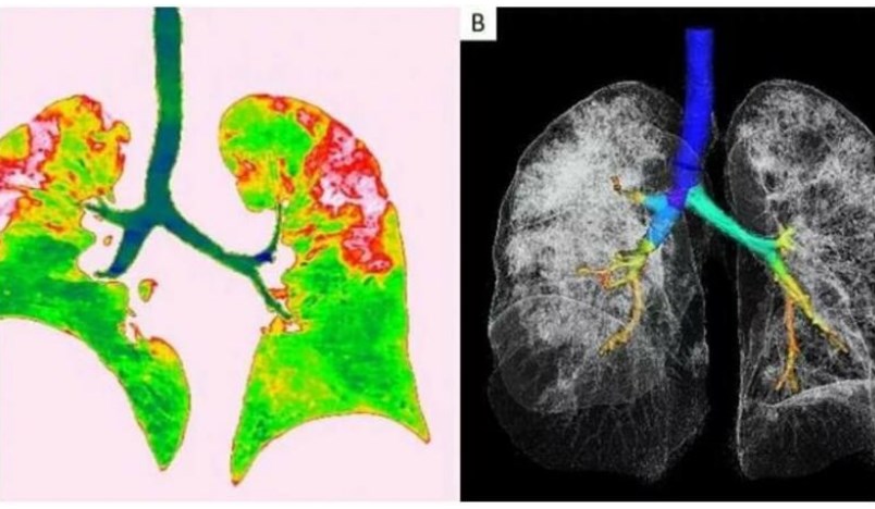Koronavirusdan sağalanların ağciyərlərində elə şeylər tapıldı ki... - Dəhşətə gələcəksiniz