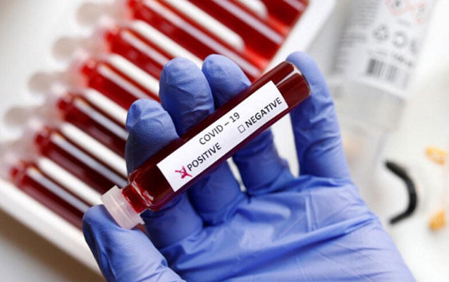 Daha 556 nəfərdə koronavirus aşkarlandı, 7 pasiyent öldü, 346 nəfər sağaldı