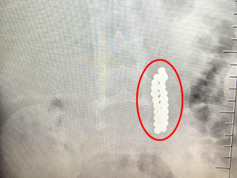 Qarnı ağrıyan uşağın mədəsindən çıxanlar həkimi də DƏHŞƏTƏ GƏTİRDİ - VİDEO - FOTO
