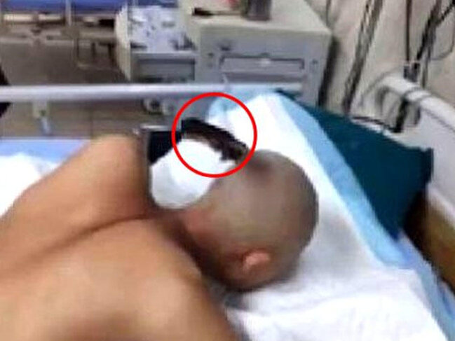 Başına bıçaq sancılmış kişi təmkini ilə təəccübləndirdi