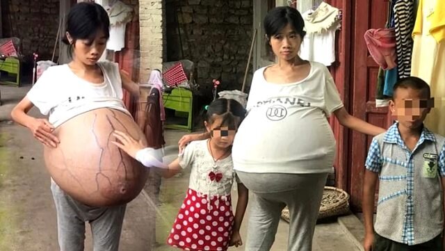 Qarınında 20 kiloluq kütlə daşıyan qadın həkimləri MAT QOYDU - FOTO-VİDEO