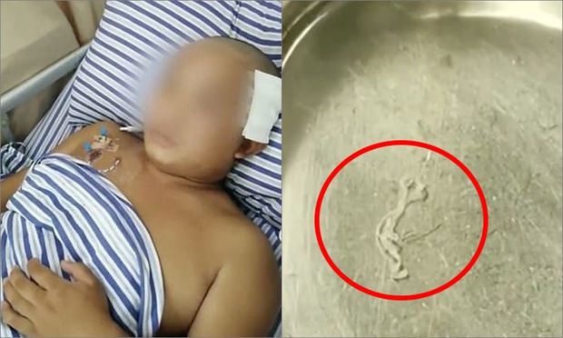 Gəncin beynindən orada 17 il yaşamış canlı qurd çıxarılıb - FOTO/VİDEO