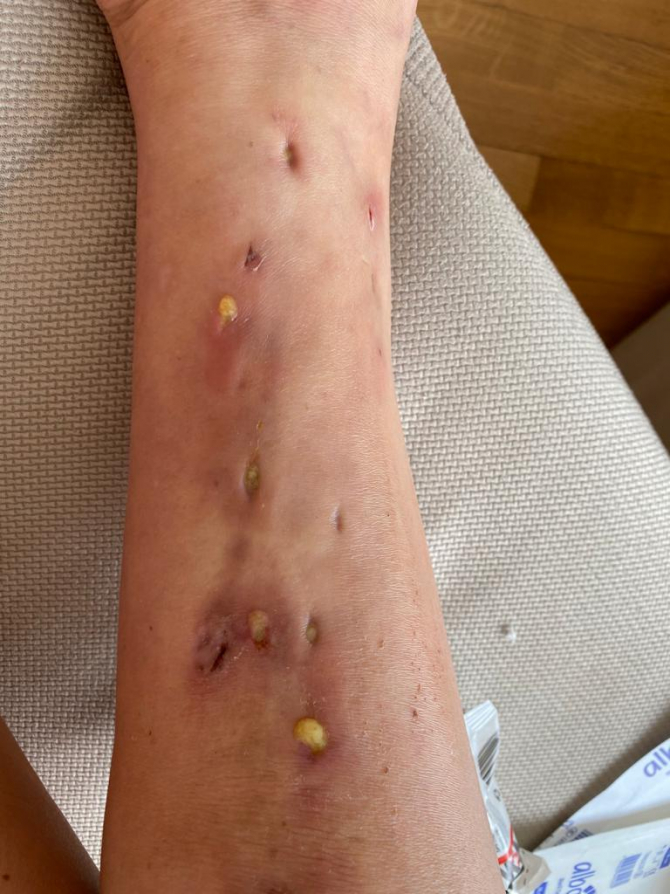 Bakıda dolğu etdirən gənc xanımın ayaqları çürüdü - FOTO