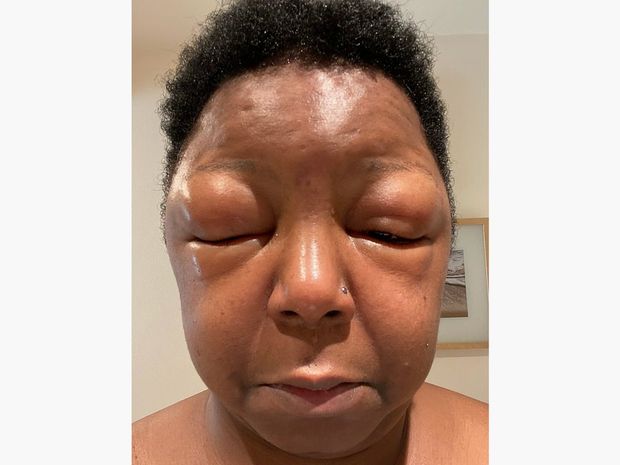 Женщина покрасилась в домашних условиях и наутро не смогла открыть глаза - ФОТО