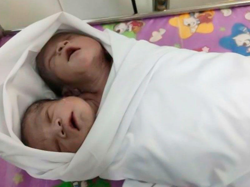 Yeni doğulan körpə hamını şoka saldı - iki başı var