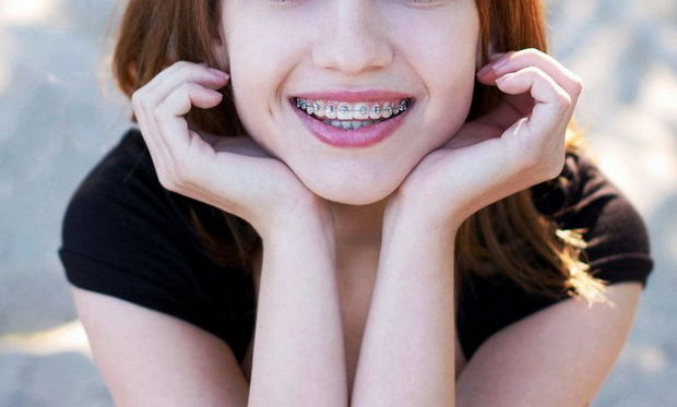 Breket qoyduran qadının ağzında xərçəng yarandı