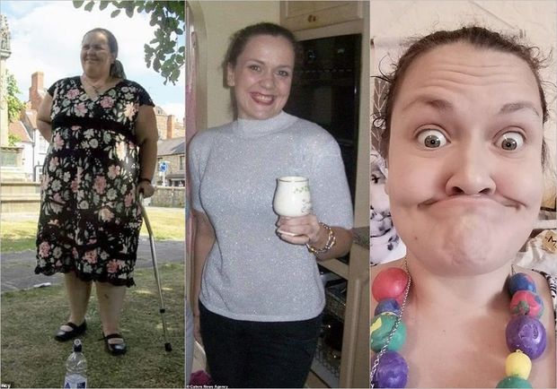 Arıqlama əməliyyatı elətdirən qadın bütün dişlərini itirib - FOTO