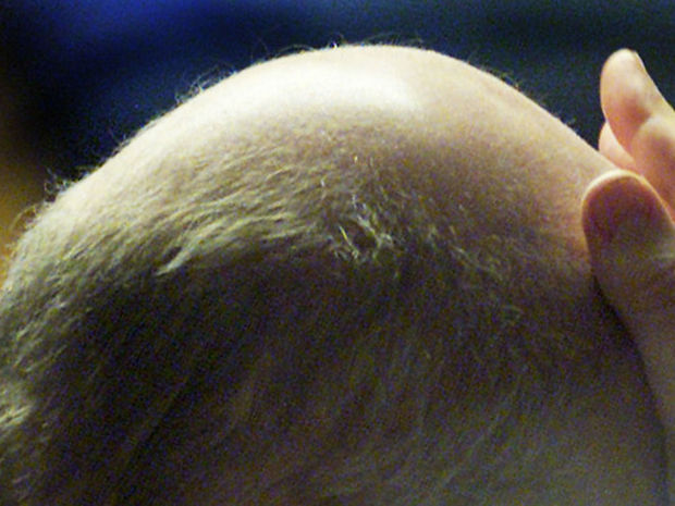 Врач раскрыл причины облысения при COVID-19