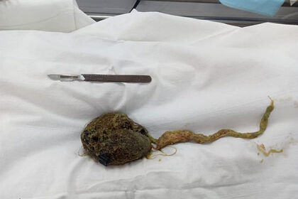 16 yaşlı qızın mədəsindən 300 qramlıq tük topası çıxarıldı