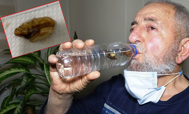 Koronavirusundan şübhələndilər, ağciyərdən qoz çıxdı - FOTO
