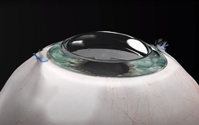 Görməni bərpa edən süni implant yaradıldı