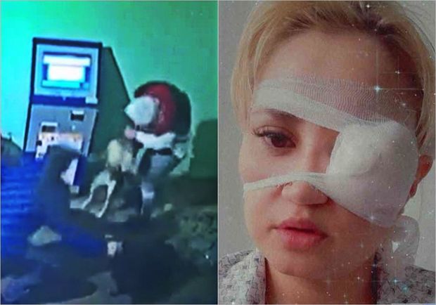 İtin dişlədiyi qadın gözünü itirmək təhlükəsi ilə üzləşdi - ANBAAN VİDEO