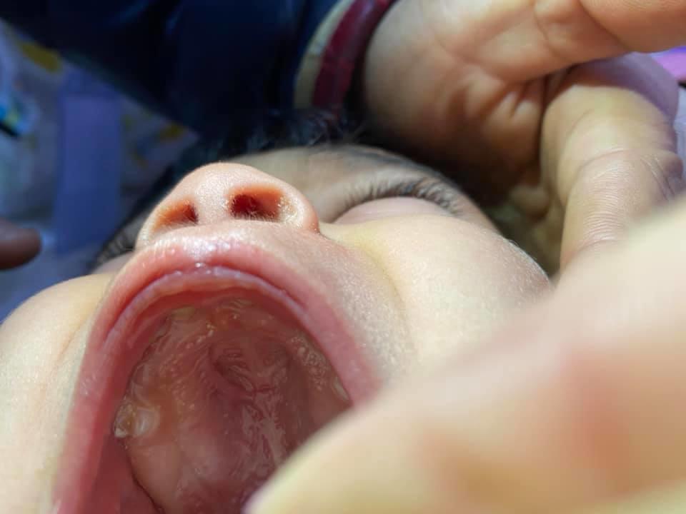 Bakıda uşağın ağzından çıxan yad cisim təəccübləndirdi - 2 aydır bu vəziyyətdə... - FOTO