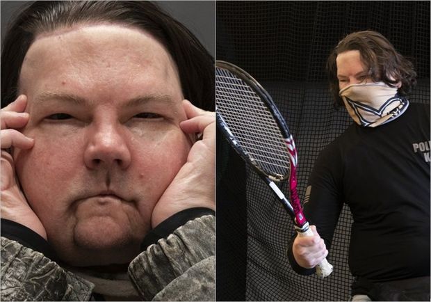 Yaşamaq üçün yeni şans: Üz və əl transplantasiyası olan şəxs həyatı yenidən öyrənir - FOTO/VİDEO