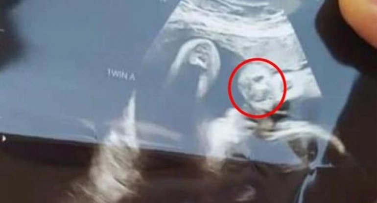 Hamilə qadın ultrasəs müayinəsi zamanı böyük şok yaşadı - FOTOLAR