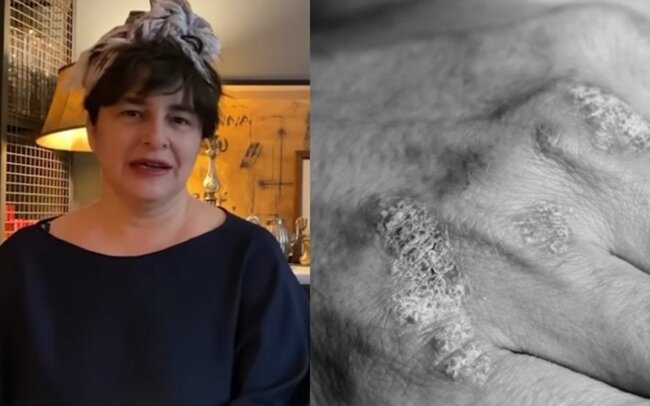 Məşhur aktrisa bu xəstəlikdən əziyyət çəkir - FOTO