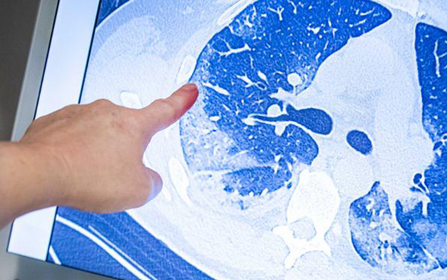 Koronavirus hansı halda ağciyərdə fəsad saxlayır?