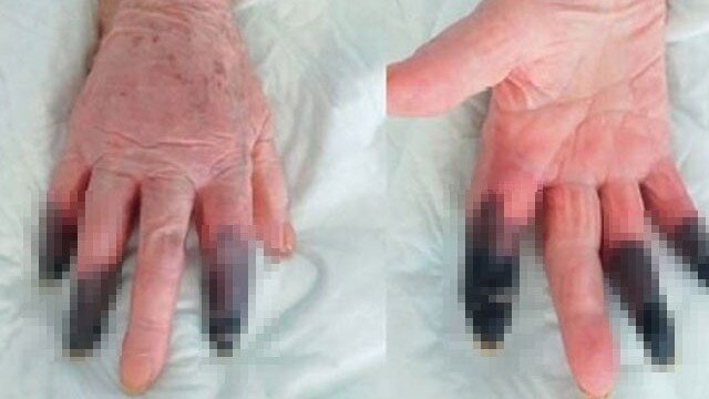 Koronavirus səbəbindən qanqrena oldu - 3 barmağı KƏSİLDİ