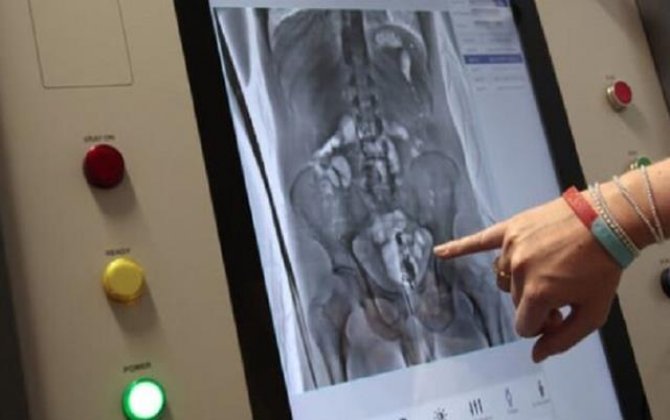 Həbsxanadan çıxan məhkumun anusundan 2 ədəd telefon çıxarıldı...