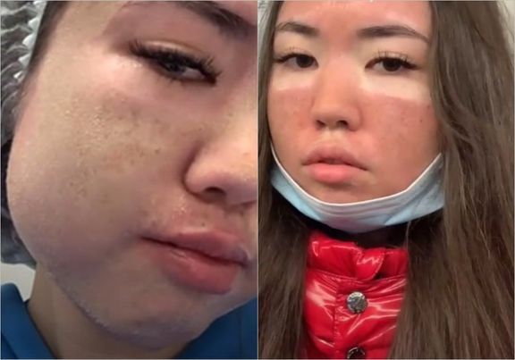 Девушка сходила к косметологу и показала страшные последствия - ВИДЕО