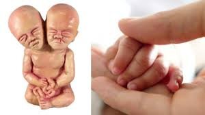 Yeni doğulan bu körpənin bir beyni İKİ BAŞI var - FOTO