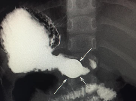 Bakıda 4 yaşlı uşağın mədəsində aşkar edilən metal TƏƏCCÜBLƏNDİRDİ - FOTO