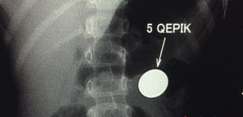 Bakıda 4 yaşlı uşağın mədəsində qəpik AŞKARLANDI