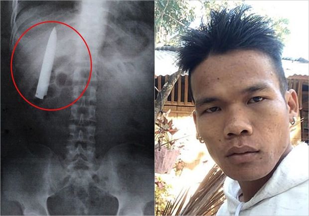 Sinəsinə saplanan bıçaqdan bir il xəbəri olmadı - FOTO