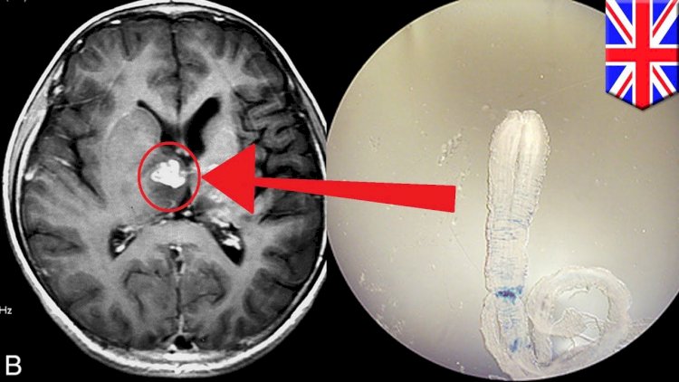 Başınızda bu əlamətlər varsa, deməli beyninizdə qurd var