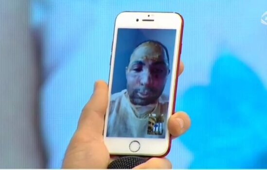 Sevgilisi tərəfindən yandırılan Əlidən ŞOK SÖZLƏR: 