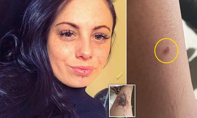 3 ay solariuma getdi, ayağındakı kiçik xal BU HALA DÜŞDÜ - DƏHŞƏTLİ FOTOLAR