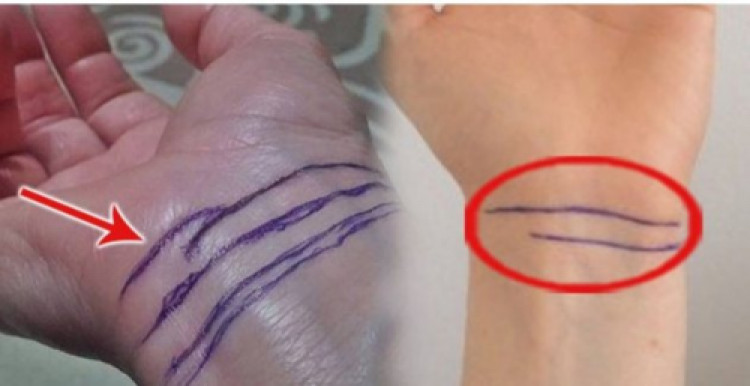 Qorxulu işarə! sizin də biləyinizdə belə “Qolbaq”varmı? əgər varsa, onun mənası budur!