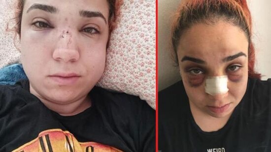 Müdir işdə telefonla danışan Zeynəbi süpürgəylə DÖYÜB BU HALA SALDI - FOTO