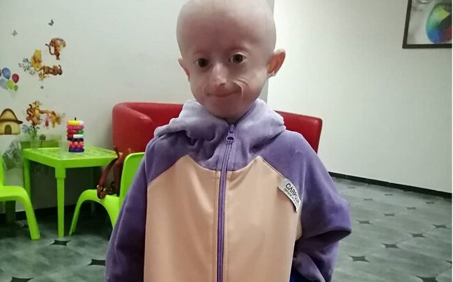 10 yaşlı qız qocalıqdan öldü - VİDEO