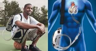 Kürəyində süni ürəklə 555 gün yaşadı - FOTO-VİDEO