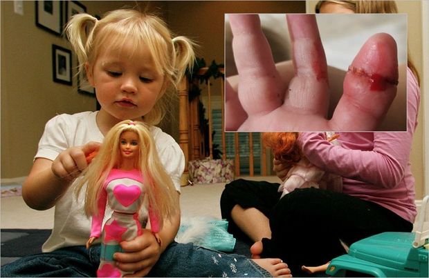 Balaca uşaq gəlinciyin saçına görə barmağını itirəcəkdi - FOTO