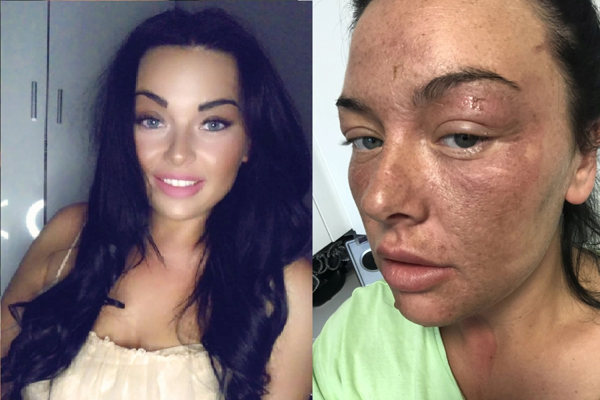 “TikTok”dakı üsulla yumurta bişirməyə çalışan qadının bütün üzü yandı - VİDEO