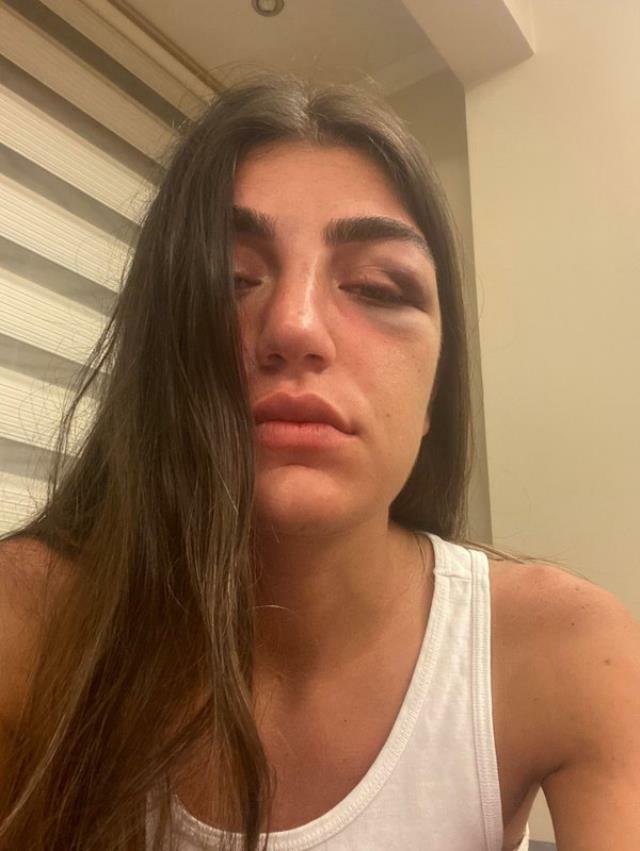 Gecə klubuna gedən modeli sevgilisi döydü, burnunu qırdı - VİDEO - FOTO