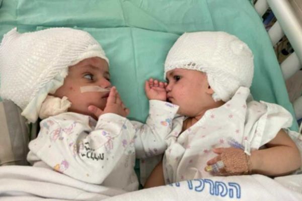 İsraildə siam əkizlərinin ayrılması üzrə uğurlu əməliyyat keçirilib – VİDEO