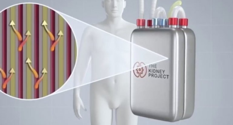 Süni böyrək yaradılır - YENİ KƏŞF