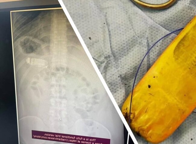 Həkimlər ŞOKDA: Mədəsindən TELEFON ÇIXDI - FOTO