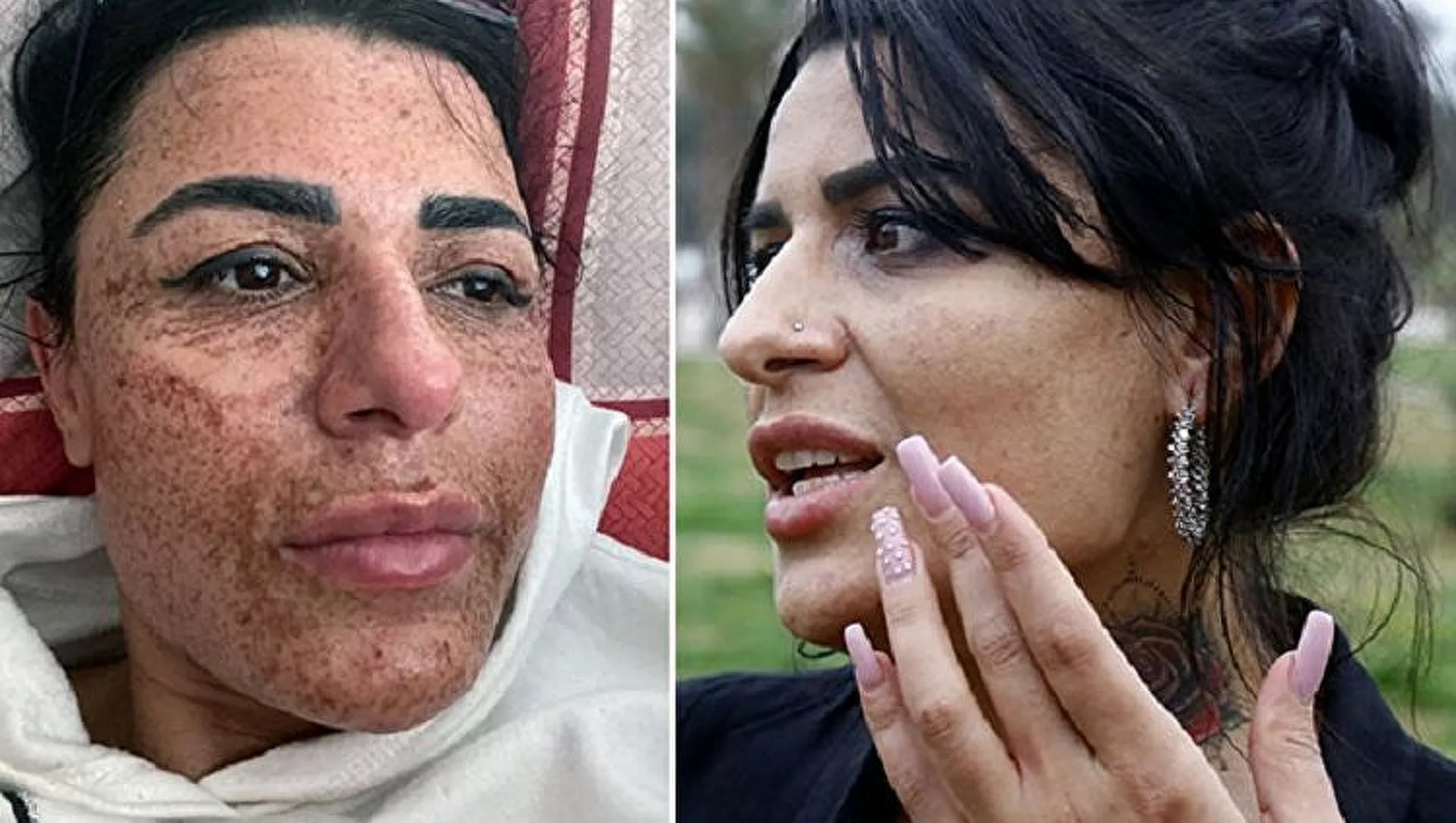 Lazer epilyasiyası zamanı qadının üzünü yandırıb bu hala saldılar – FOTO