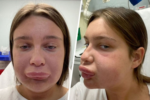 Женщина стала похожа на Гомера Симпсона после неудачной инъекции в губы - ВИДЕО