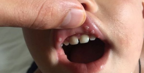 Azərbaycanda daha bir virus sürətlə yayılmağa başladı - 10 gün içində ...