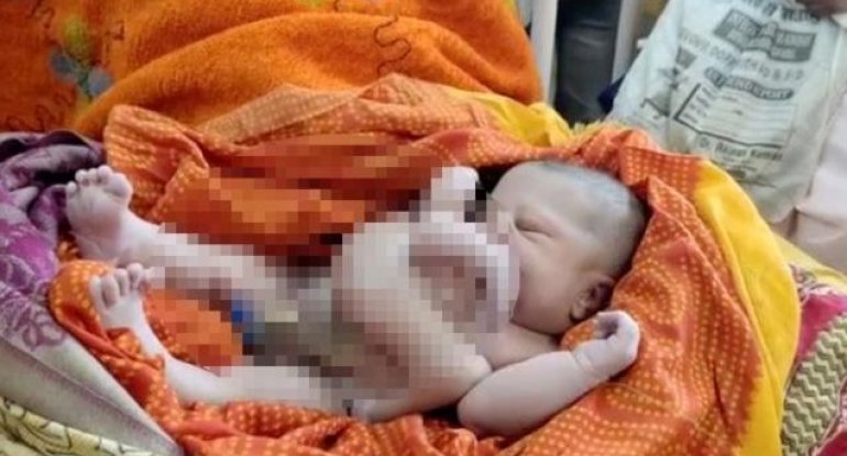 Dörd qolu və dörd ayağı olan körpə dünyaya gəldi - FOTO