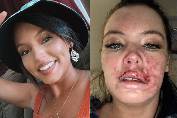 Daha gözəl görünmək istəyərkən dodağını itirmək təhlükəsi ilə üzləşdi - FOTO