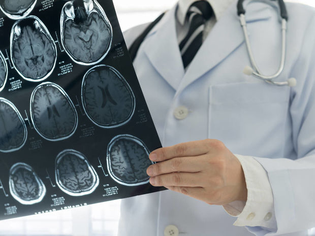 Врач назвала симптомы немого инсульта