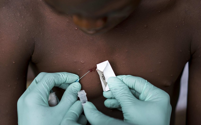 ÜST “Meymun çiçəyi” virusunun kəskin yayılması ilə bağlı təcili görüş çağırıb